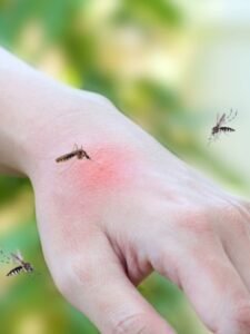 mosquitoes-bite-adult-hand-made-skin-rash-allergy-with-red-spot_293060-5007